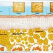 rappresentazione degli stadi della cellulite