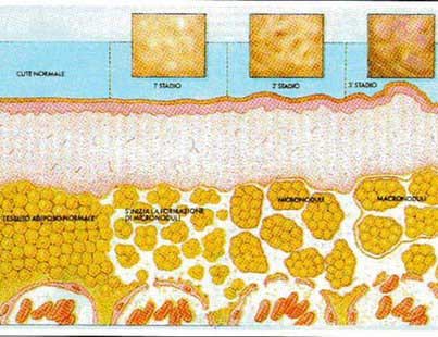 rappresentazione degli stadi della cellulite