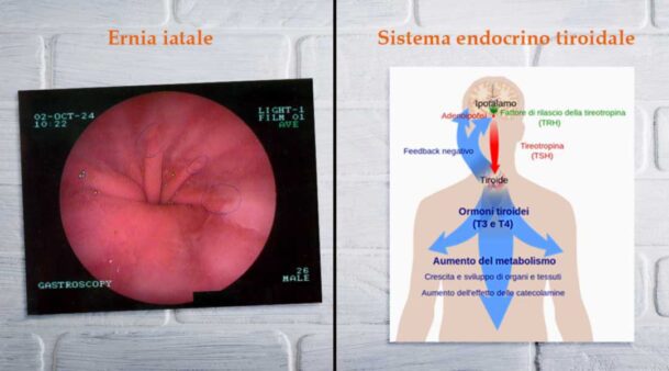 ernia iatale ipotiroidismo